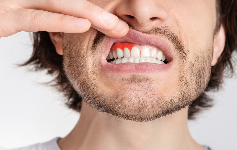 Un homme présente des signes de maladies gingivales, dont le traitement relève de la parodontie